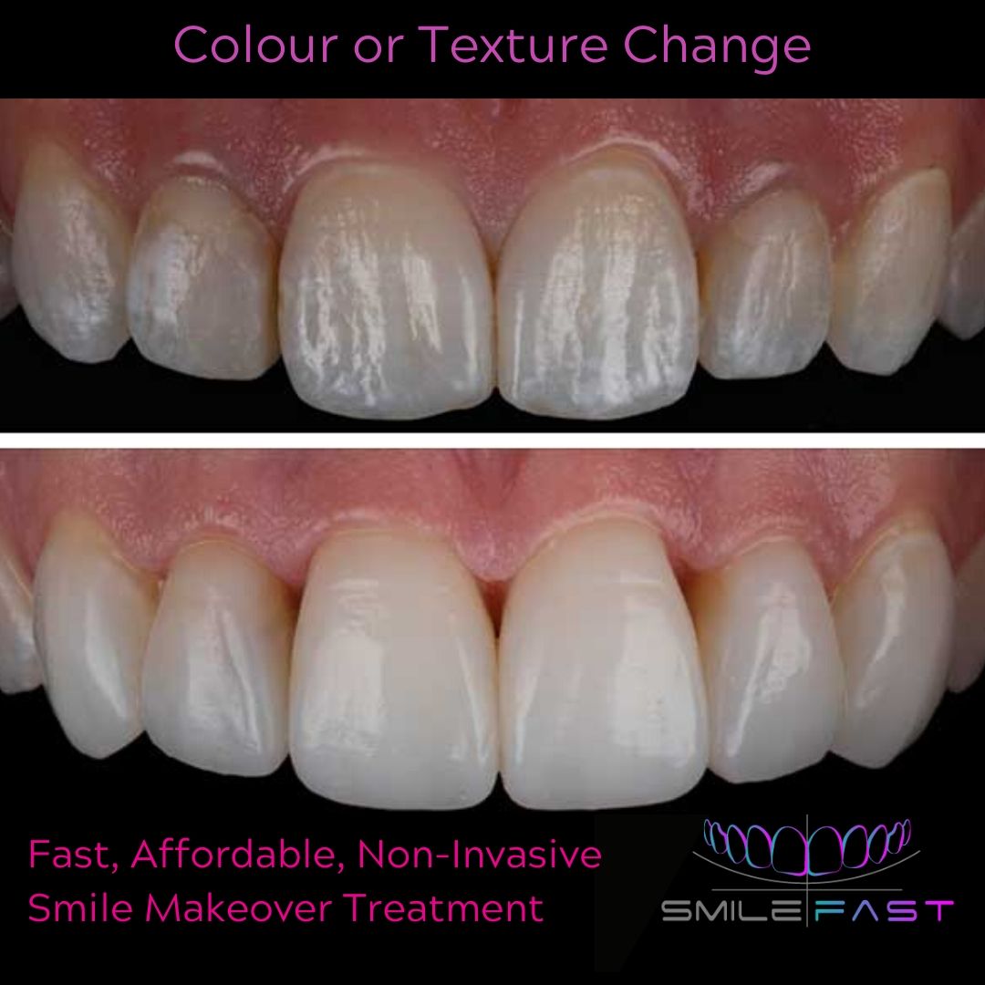 Smilefast Affordable Veneers