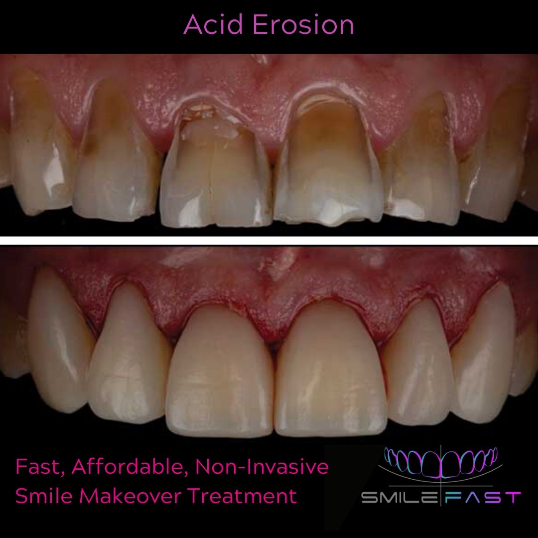 Smilefast Affordable Veneers