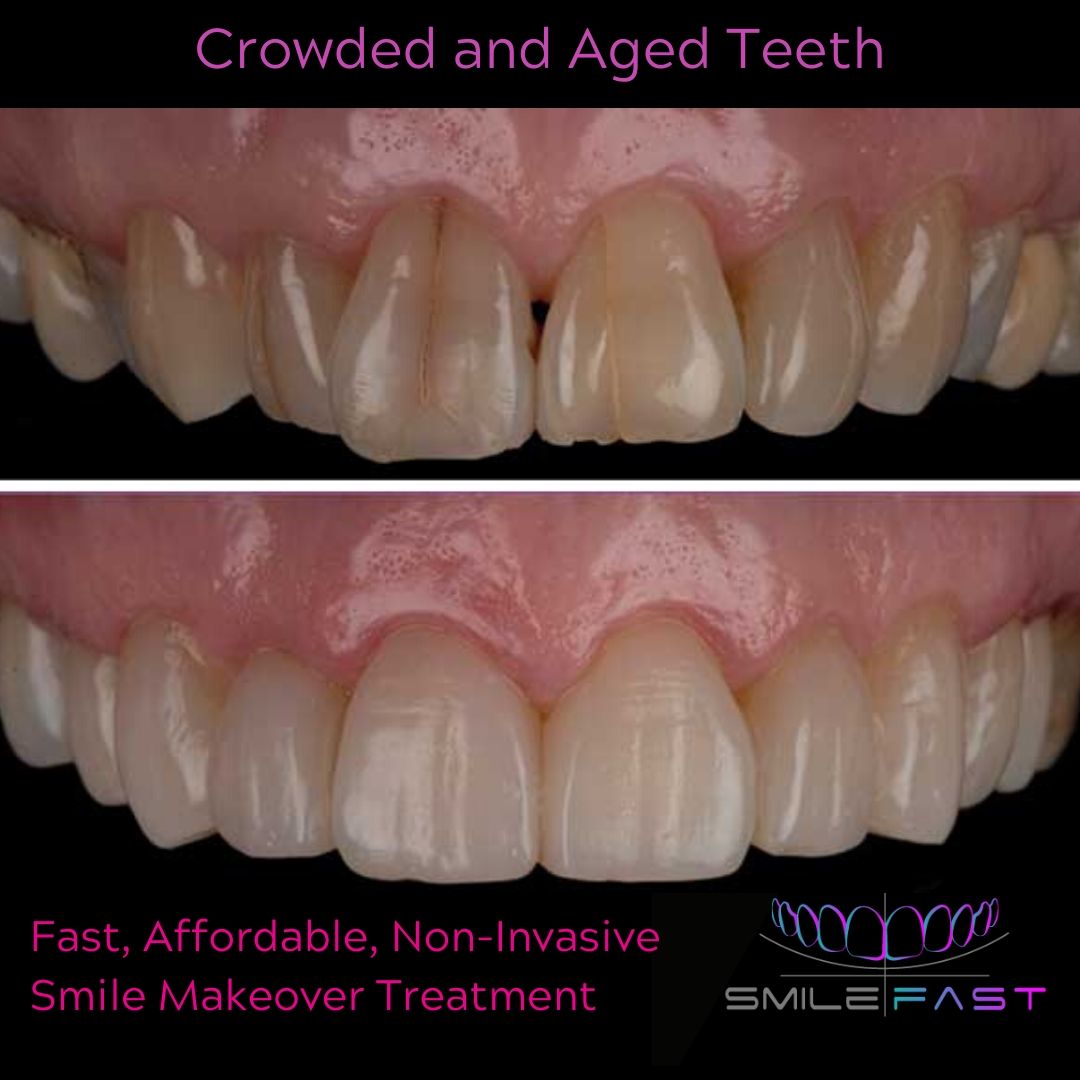 Smilefast Affordable Veneers
