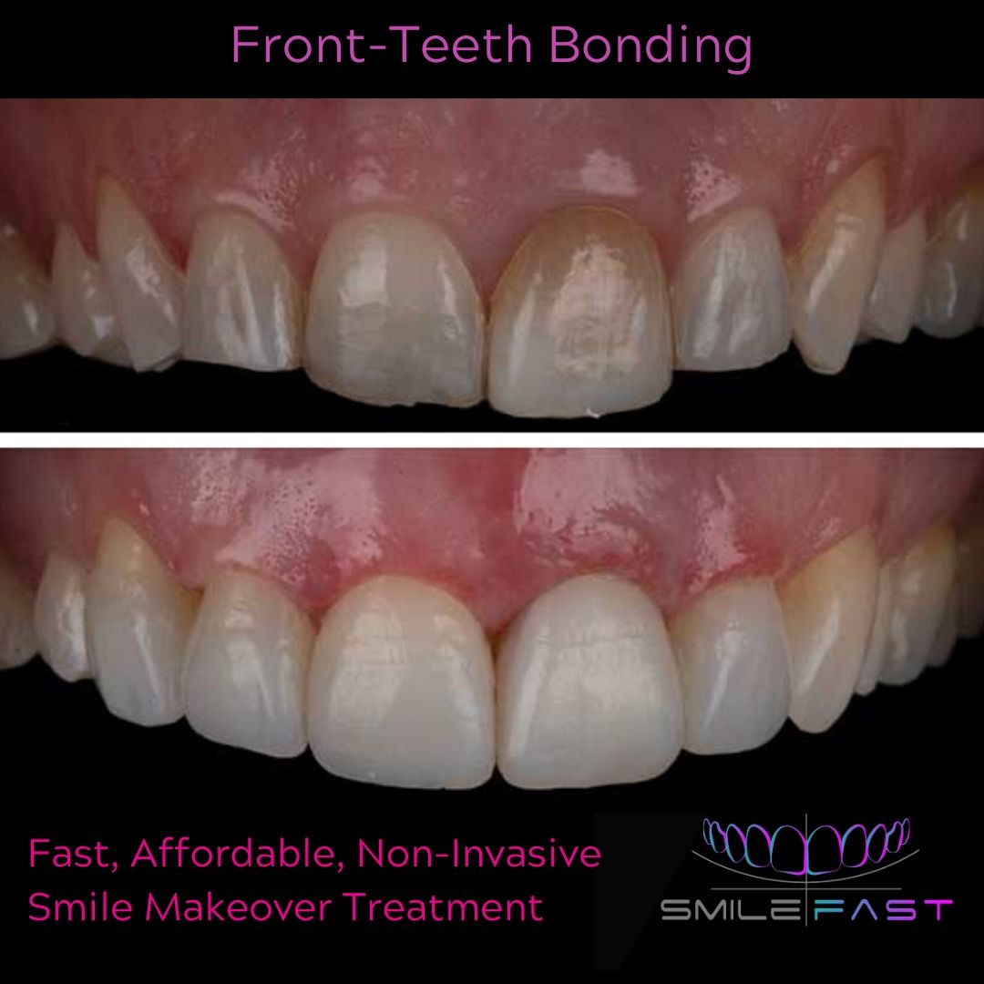 Smilefast Affordable Veneers