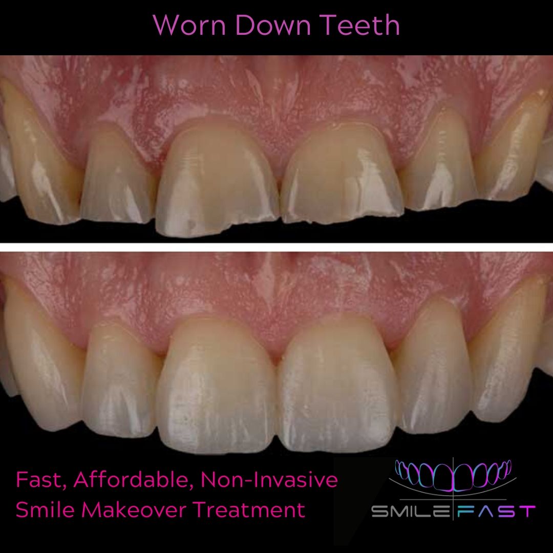 Smilefast Affordable Veneers