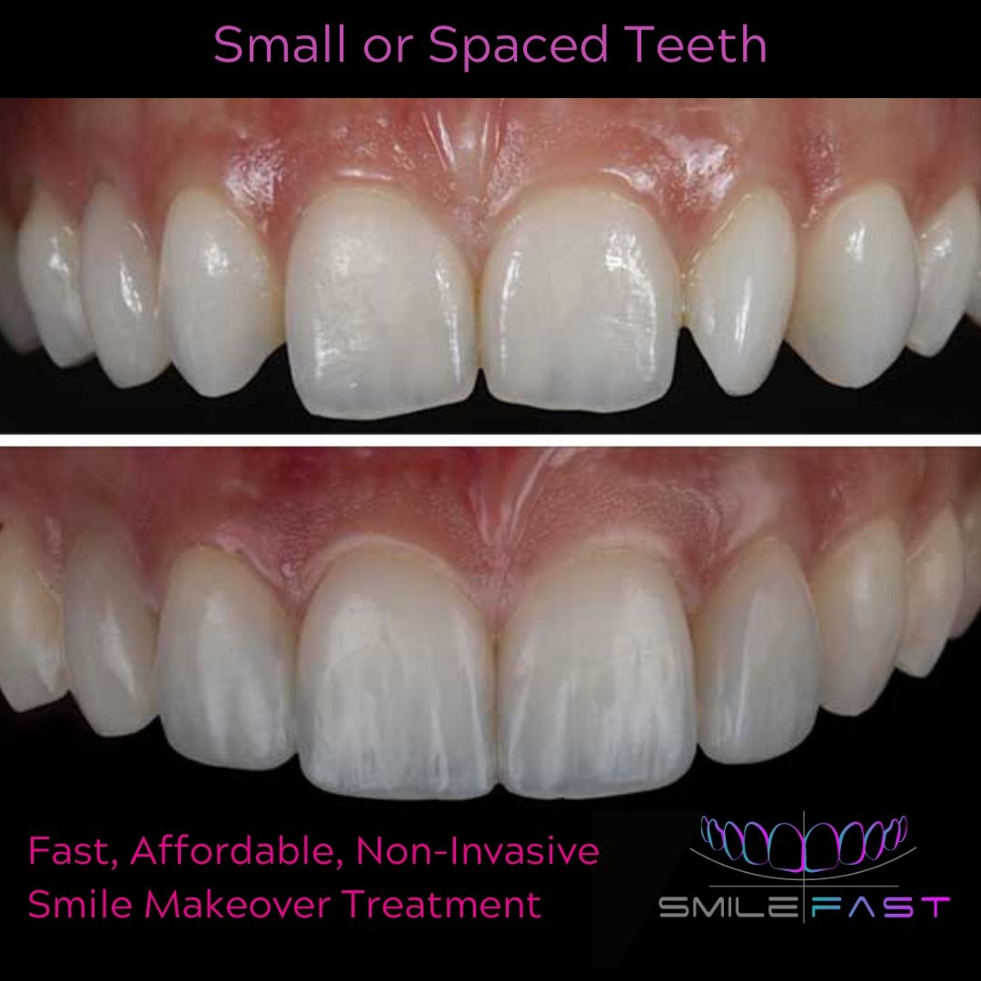 Smilefast Affordable Veneers