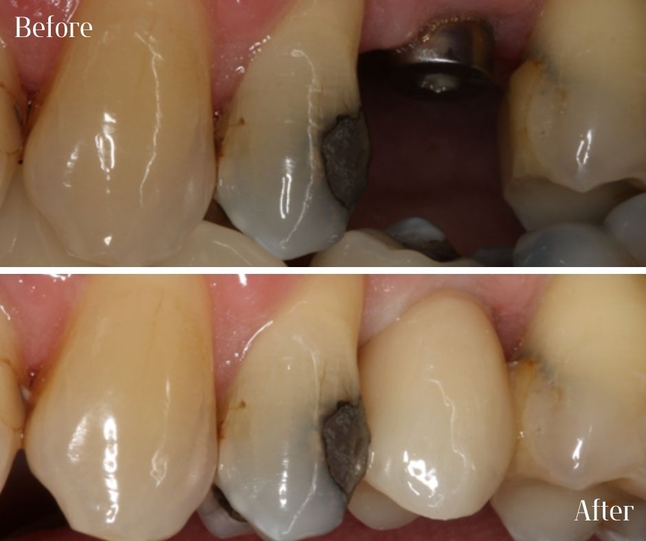 Patient Gallery - 740 Dental