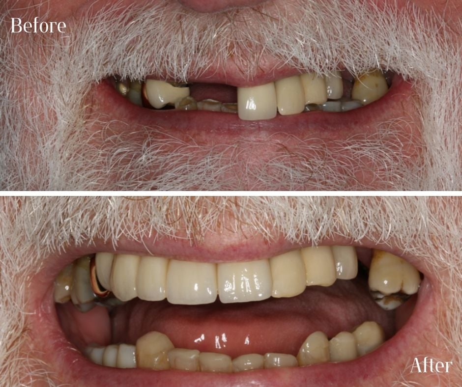 Dental Implants treatment photos