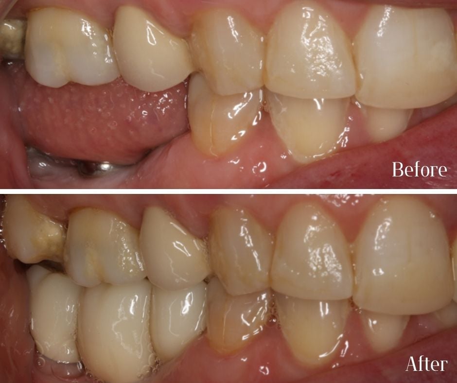Dental Implants treatment photos
