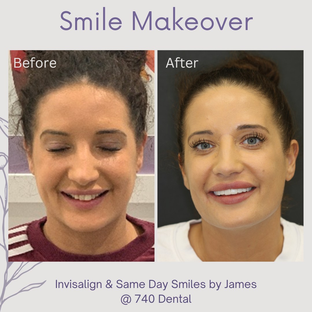 Dental Veneers