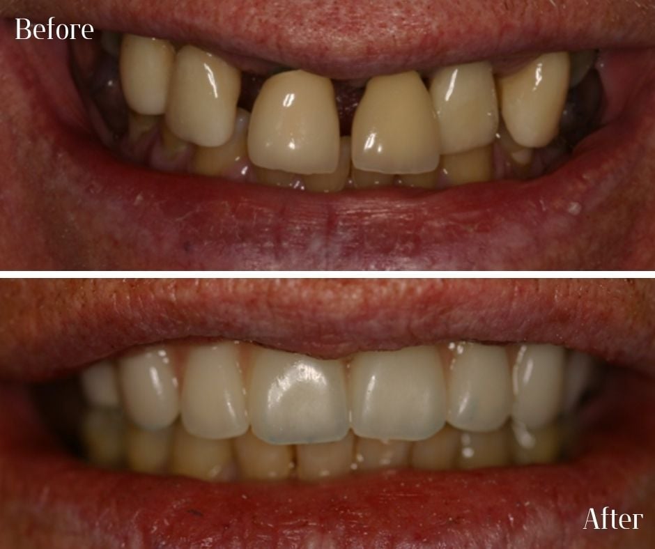 Dental Implants treatment photos