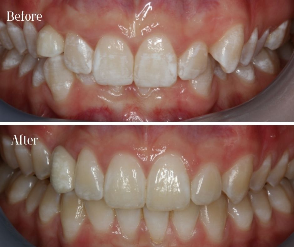 Patient Gallery - 740 Dental