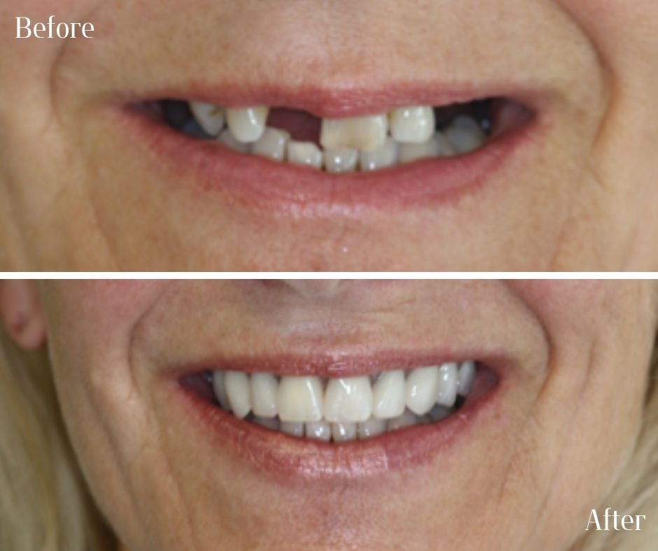Dental Implants treatment photos