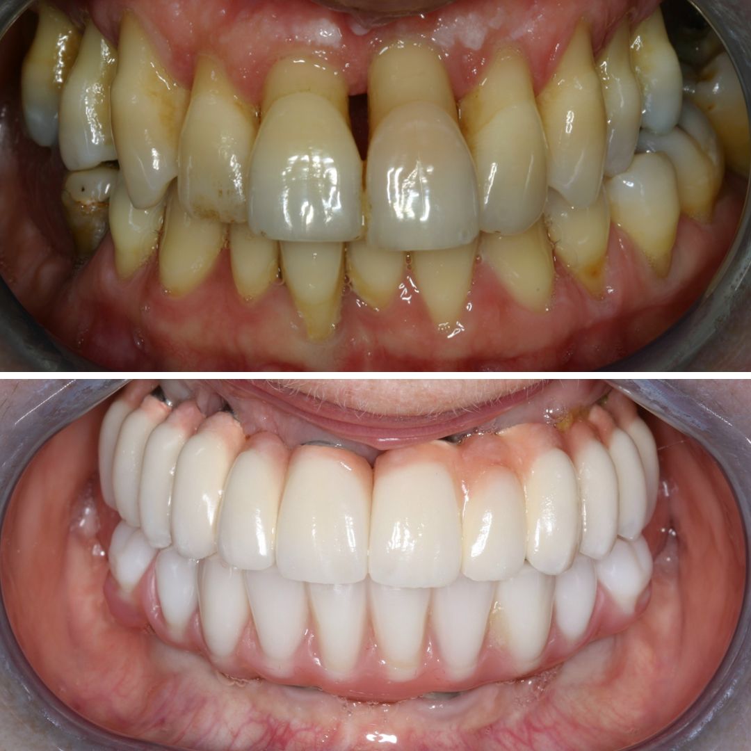 Dental Implants treatment photos