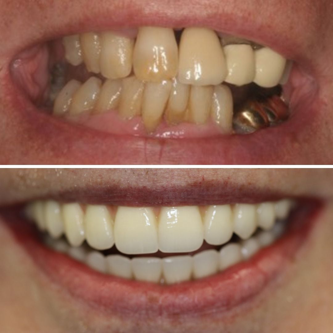 Dental Implants treatment photos