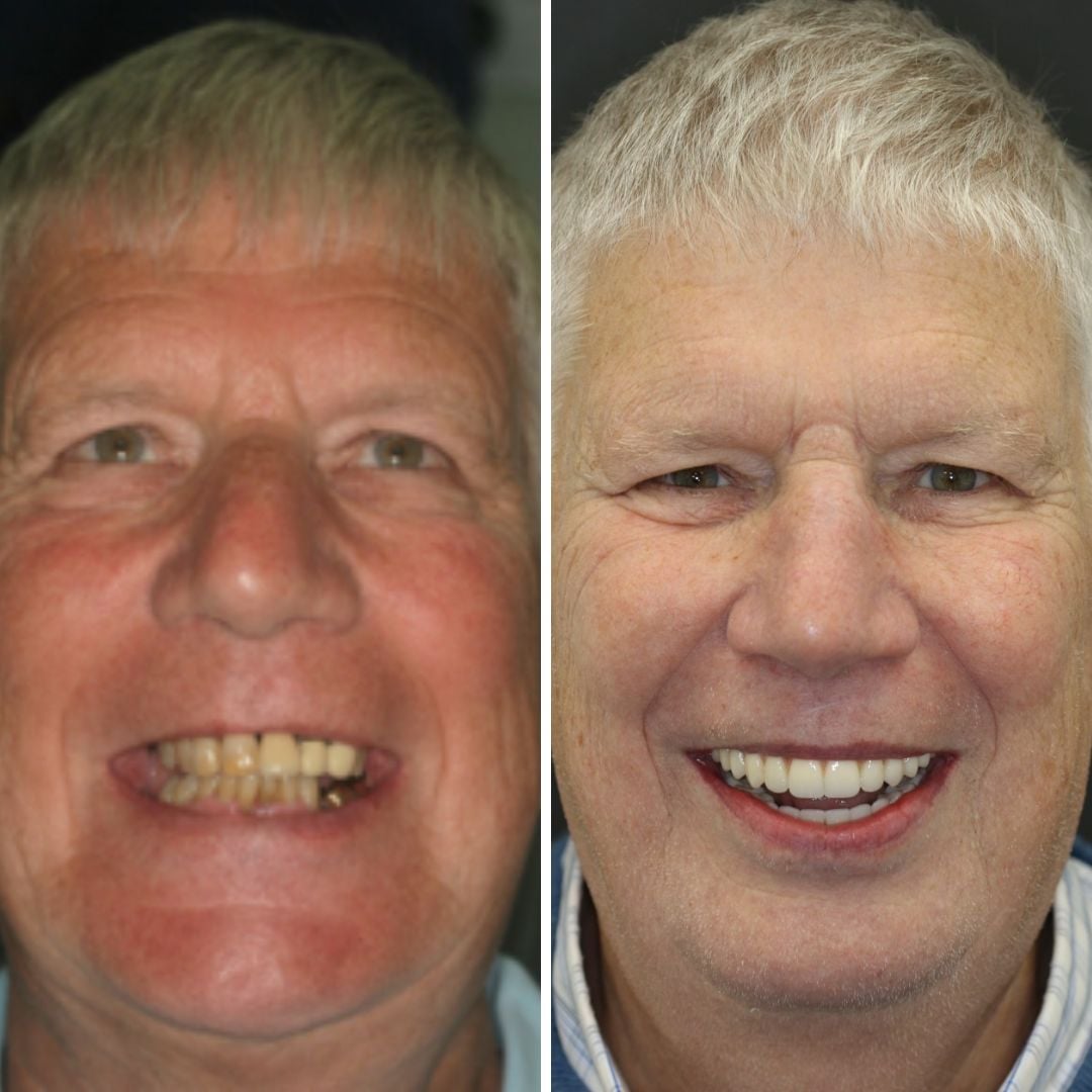 740 Dental – Your Destination For Dental Implants In Bournemouth