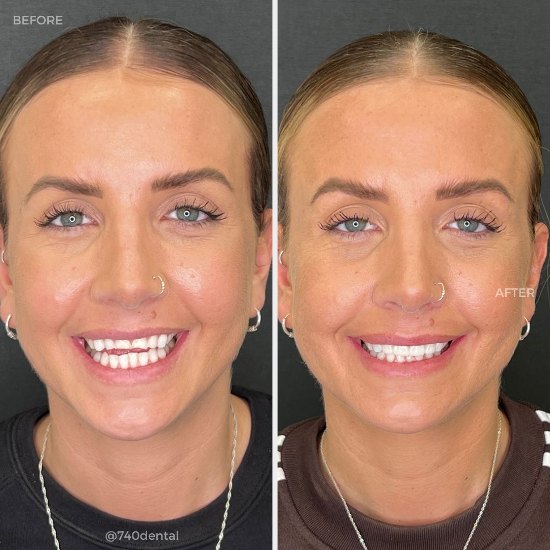 Before and after teeth whitening