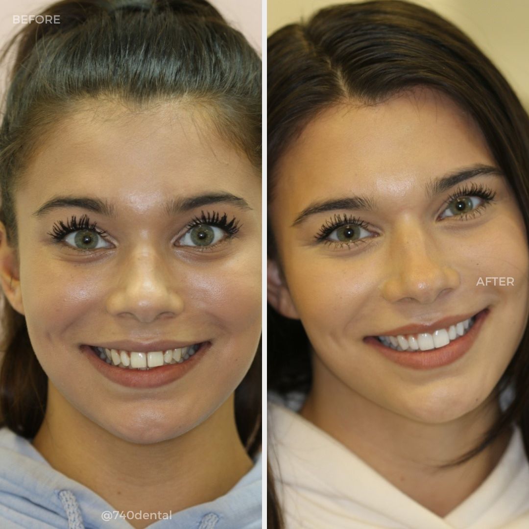 Before and after teeth whitening