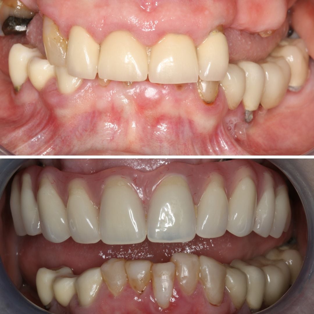 Dental Implants treatment photos