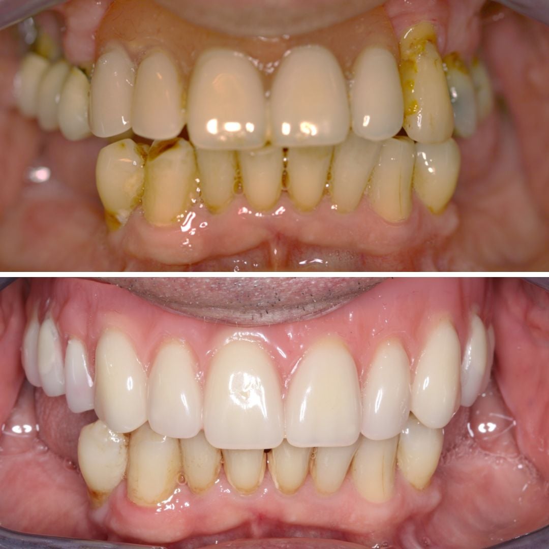 Dental Implants treatment photos