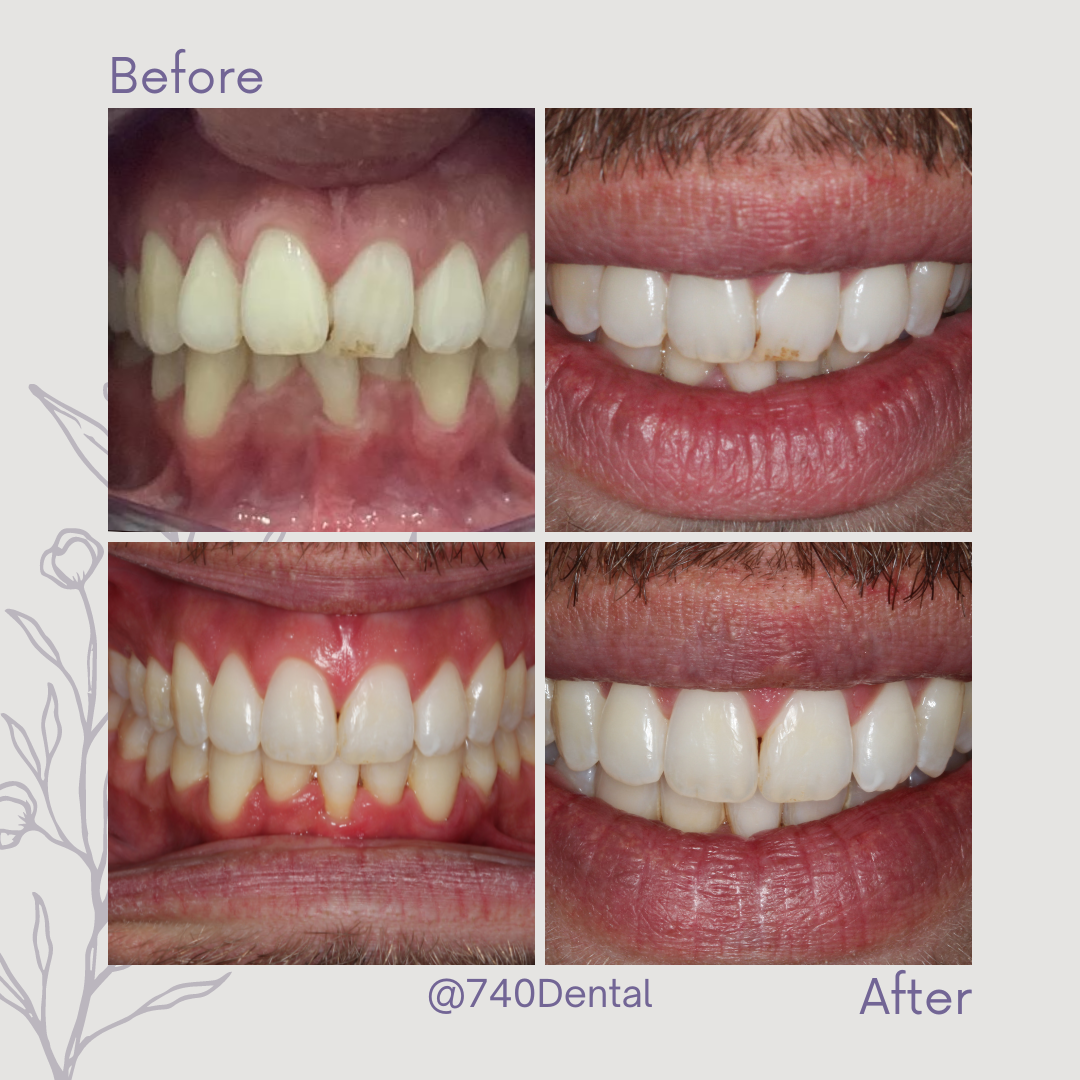 Straight Teeth Braces - 740 Dental