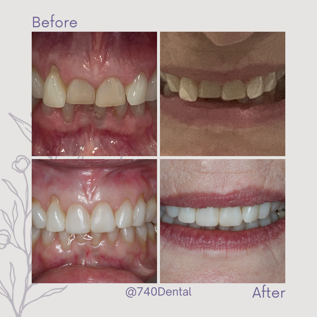 Straight Teeth Braces - 740 Dental