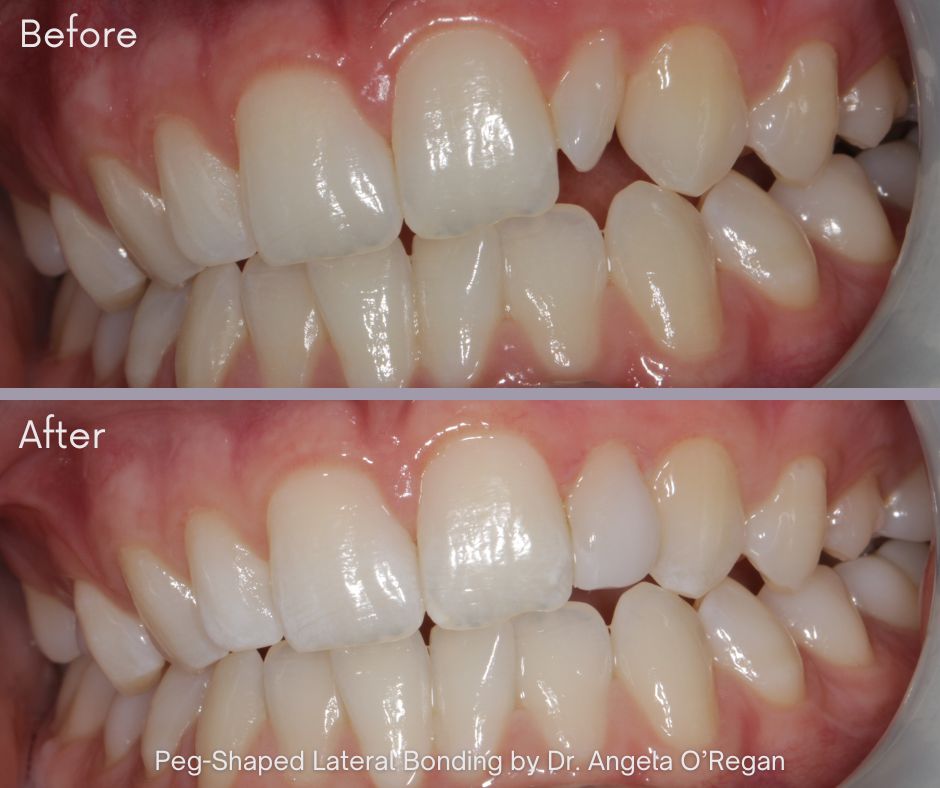 Peg-Shaped Lateral Bonding by Dr. Angela O’Regan (1) - Patient Gallery