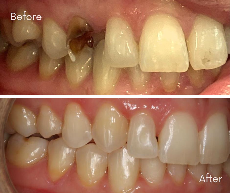 Invisalign® Bournemouth - 740 Dental