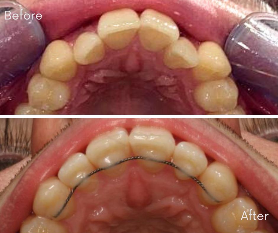 Invisalign® Bournemouth - 740 Dental