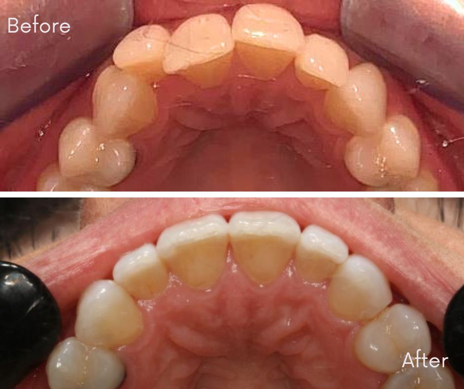 Invisalign® Bournemouth - 740 Dental
