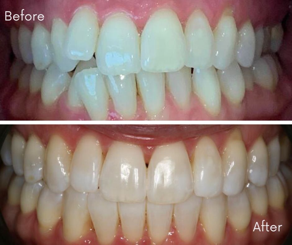 Invisalign® Bournemouth - 740 Dental