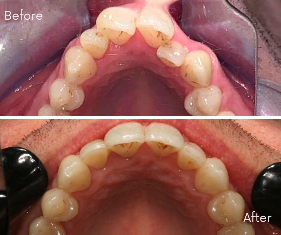 Invisalign® Bournemouth - 740 Dental