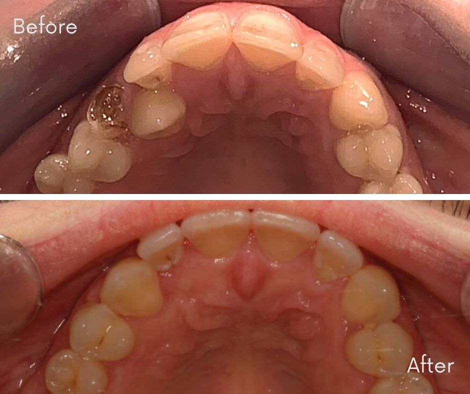 Invisalign® Bournemouth - 740 Dental