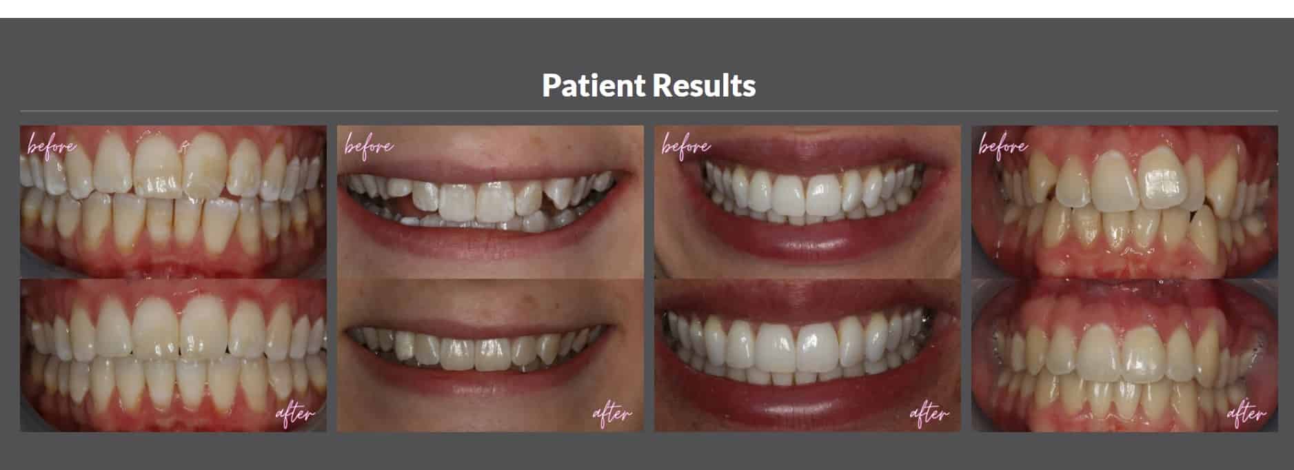 Cosmetic Dentistry - 740 Dental Patient Results