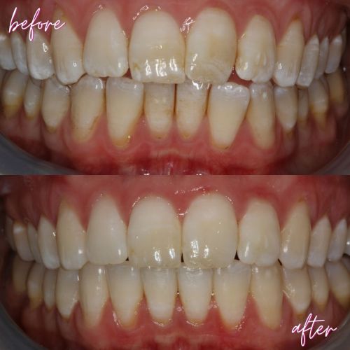 Before and After - Cosmetic dentistry